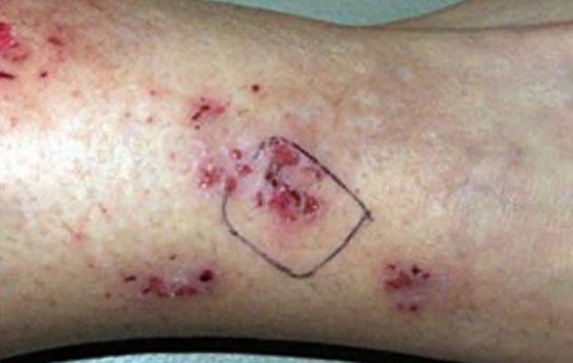 http://www.timesocket.com/disease/morgellons-disease-pictures-and-story/