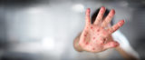 Viral Diseases - Hand Infected - Hand foot and mouth disease HFMD