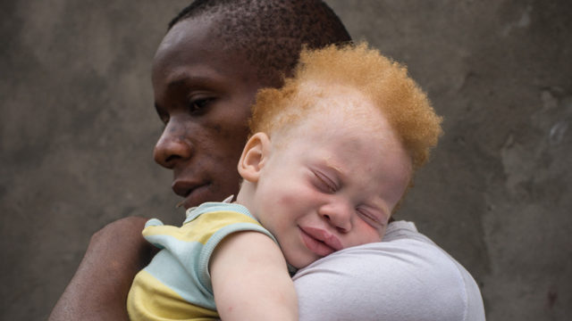 Democratic Republic of Congo (DRC), Kinshasa, black father holding his albino toddler