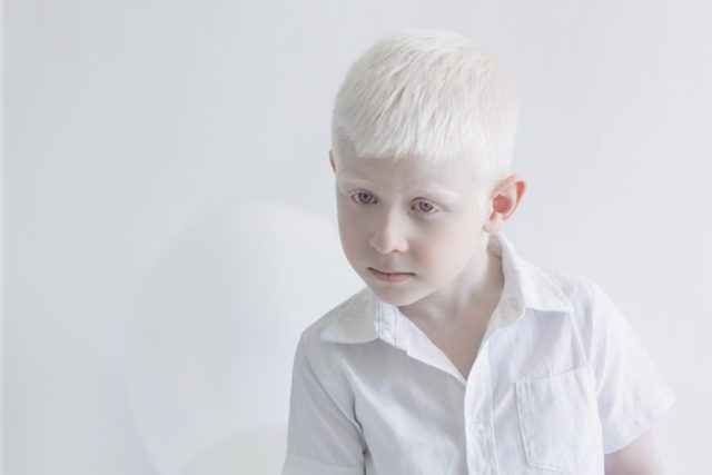 Albinism photographs yulia taits.jpg