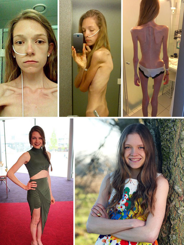 Anorexia recovery before after 130 58f7209c5d1f7__700.jpg