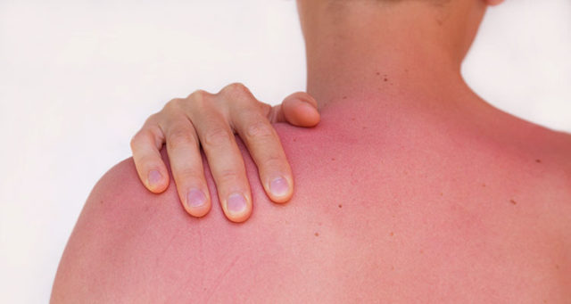 Woman with burned skin on her back.jpg