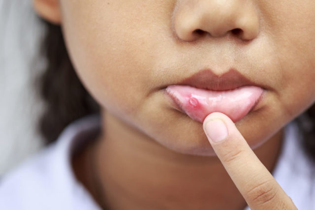 Child with canker sore 825x550.jpg