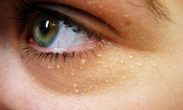 How to get rid of cholesterol deposits around the eyes without medical intervention featured.jpg