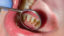 Ako odstrániť zubný kameň?