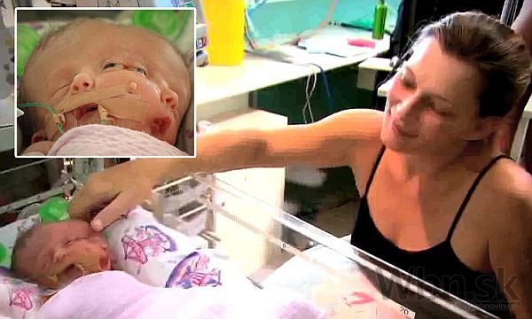 Austrálčanka porodila dvojičky s jedným telom a dvoma mozgami