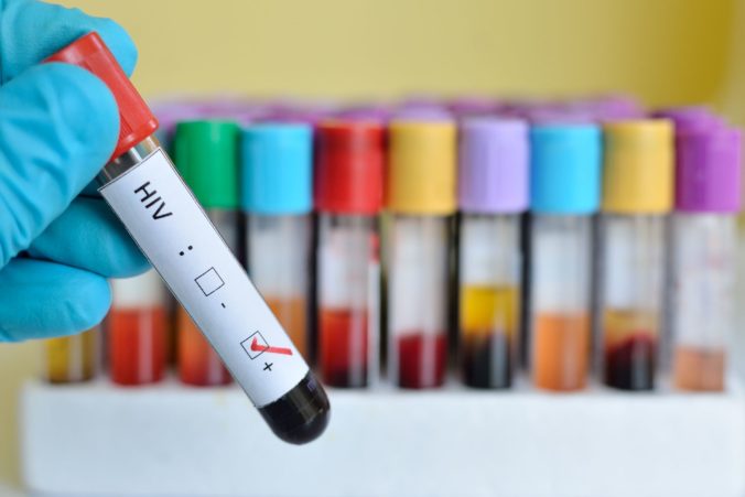 Vedci odhalili doposiaľ nepoznaný a nákazlivejší variant vírusu HIV