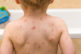 pox, and measles