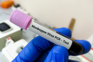 PCR test na opičie kiahne